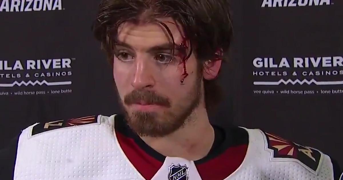 Garland gives post game interview while still bleeding from his face.